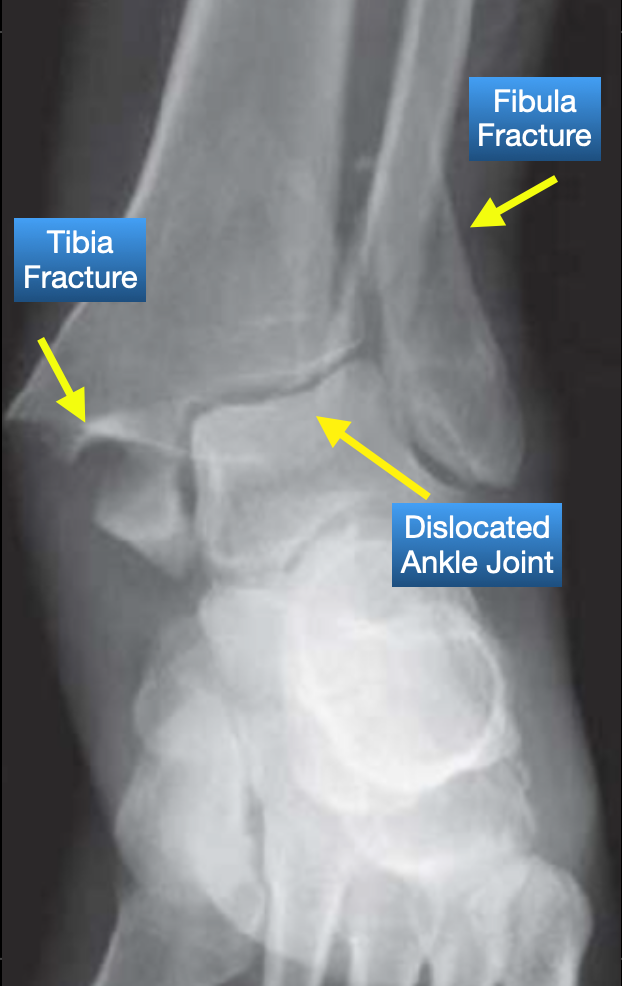 Ankle dislocation x-ray