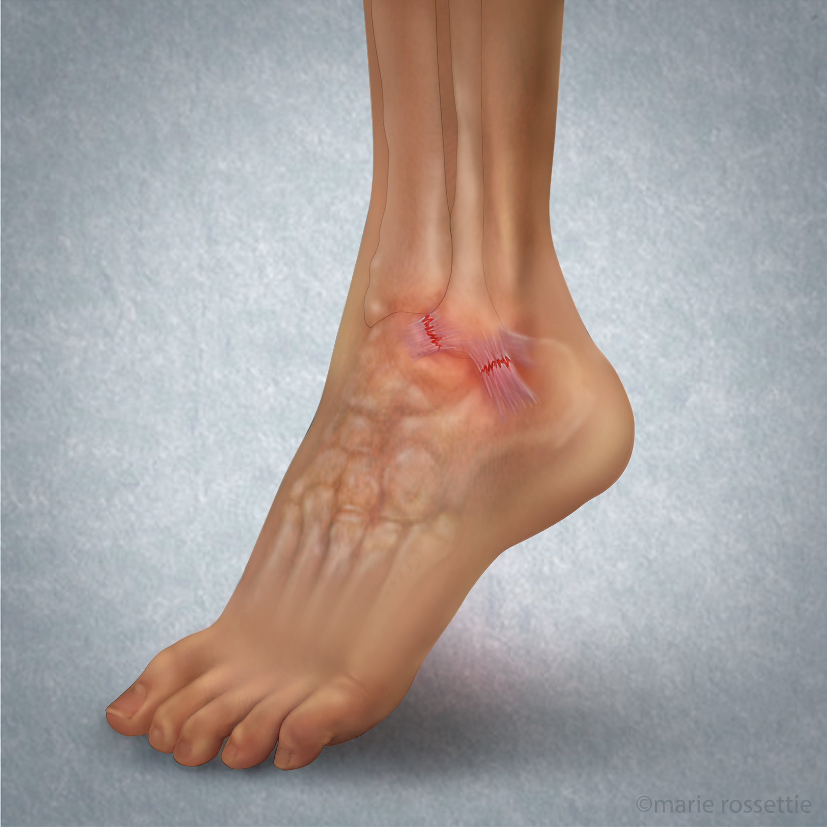 Low Ankle Sprain - Marie Rossettie Low Ankle Sprain